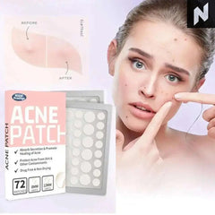 ClearSkin Hydrocolloid Acne Patches – Invisible & Healing Novo Style acne